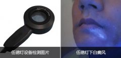 三维皮肤CT和伍德灯哪个检查白癜风更可